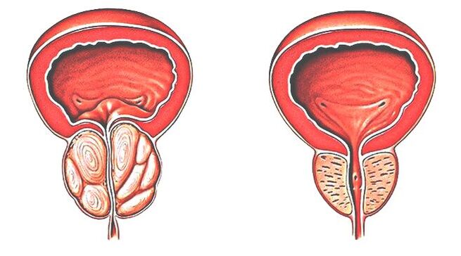 Prostatīts un normāla prostata