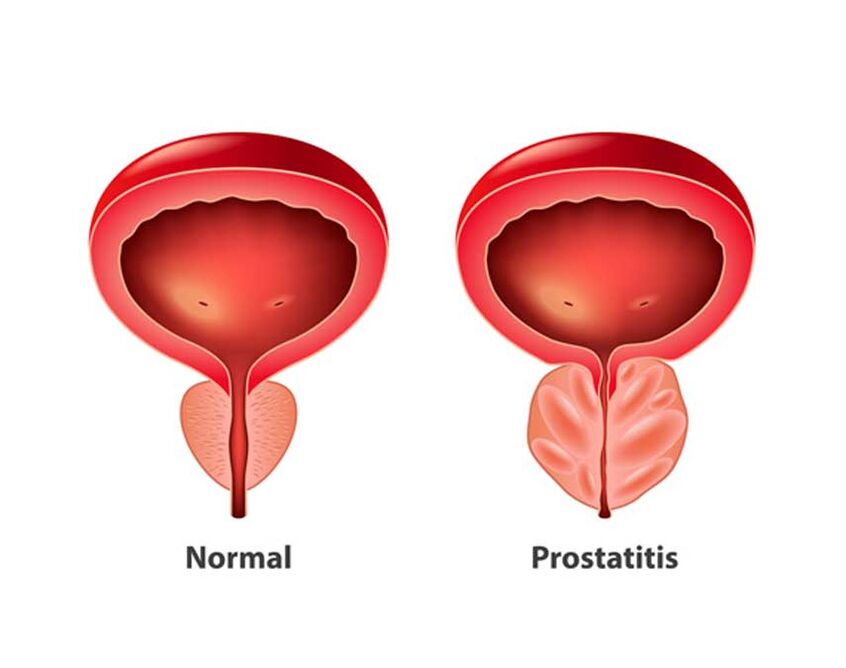 normāla un iekaisuma prostata