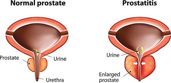 normāla un iekaista prostata