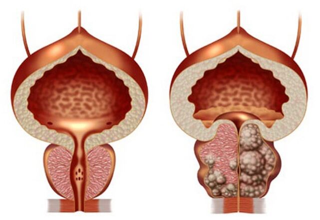 vesela prostata un prostatas adenoma
